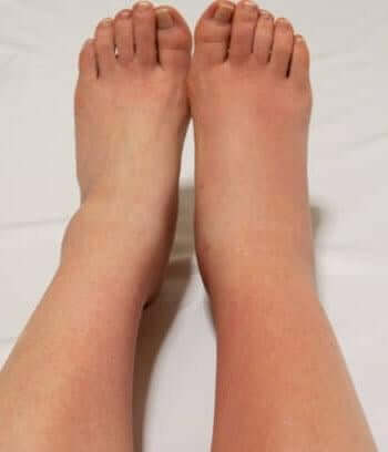 Feet-Swollen