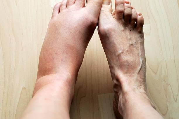 Swollen-Feet