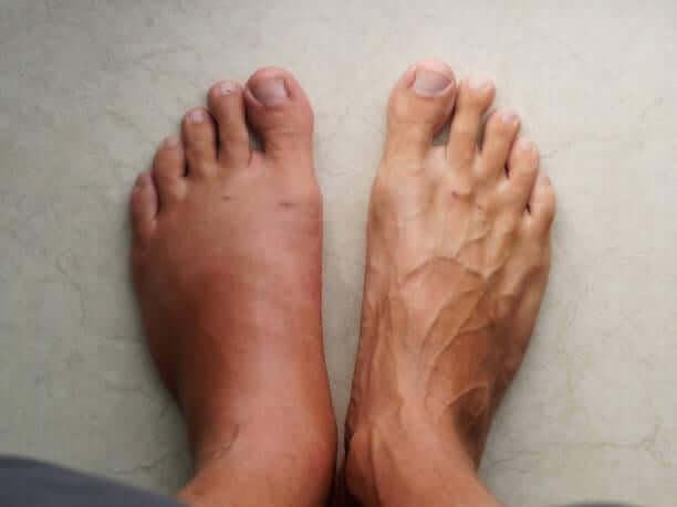 Swollen-Feet