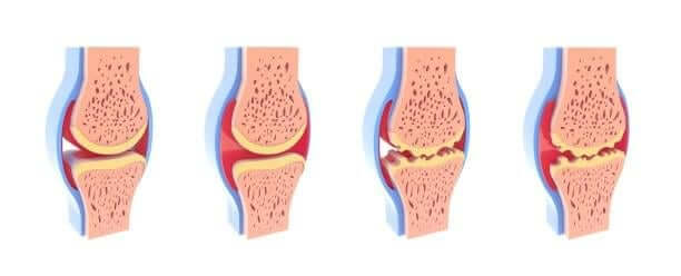 Joint-Cartilage