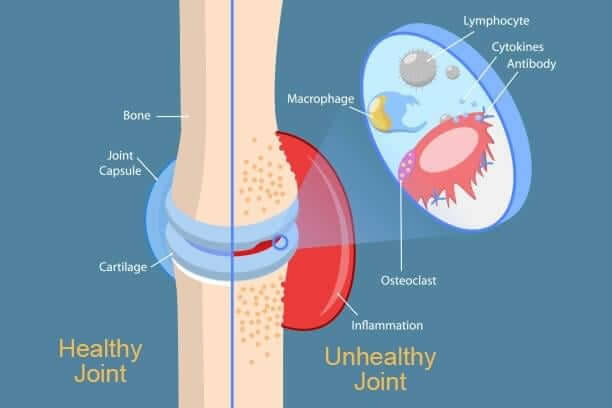 Joint-Cartilage-Diffirence