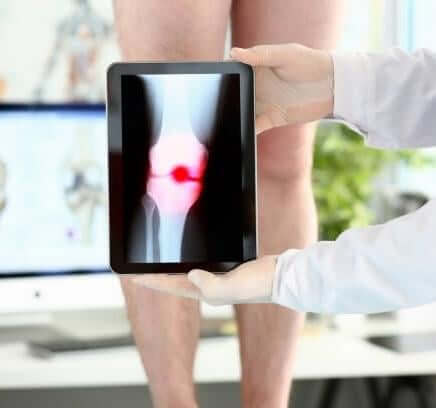 Osteoarthritis