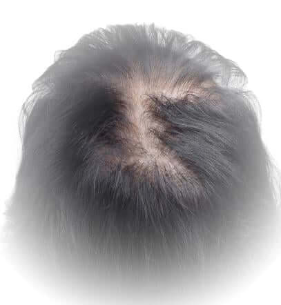 hair-loss
